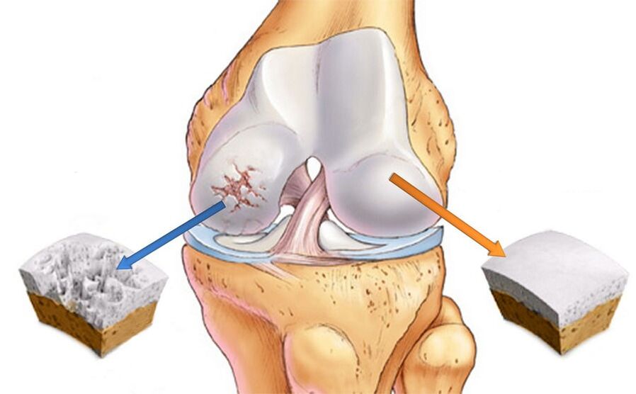 Osteoarthritis of the knee and healthy cartilage