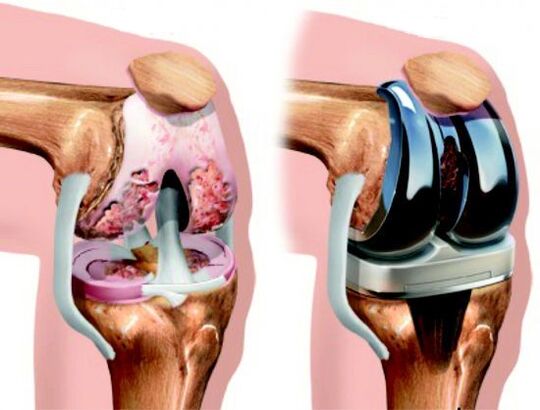 Results of knee replacement surgery to treat joint disease