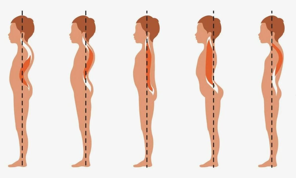 the degree of development of lumbar osteoarthritis