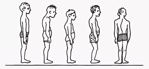 Breach of posture