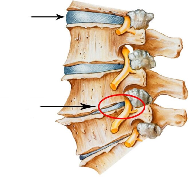 Development of disc herniation