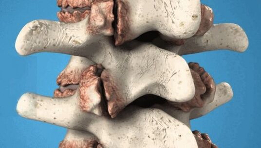 Osteophytes of the vertebrae - The development of pathology damages the nerves and blood vessels