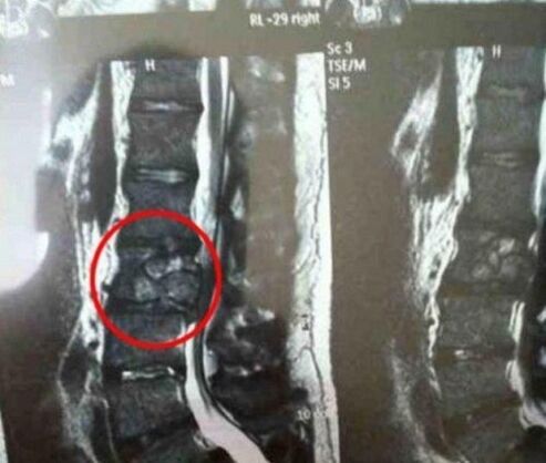 The spine tumor in the picture