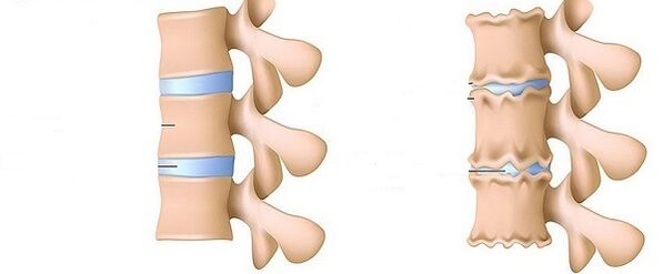 Healthy spine and spine