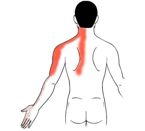 Cervical spondylosis is the cause of finger joint pain