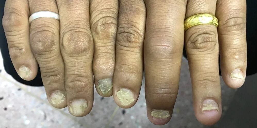 Finger swelling and nail plate deformities can be signs of psoriatic arthritis
