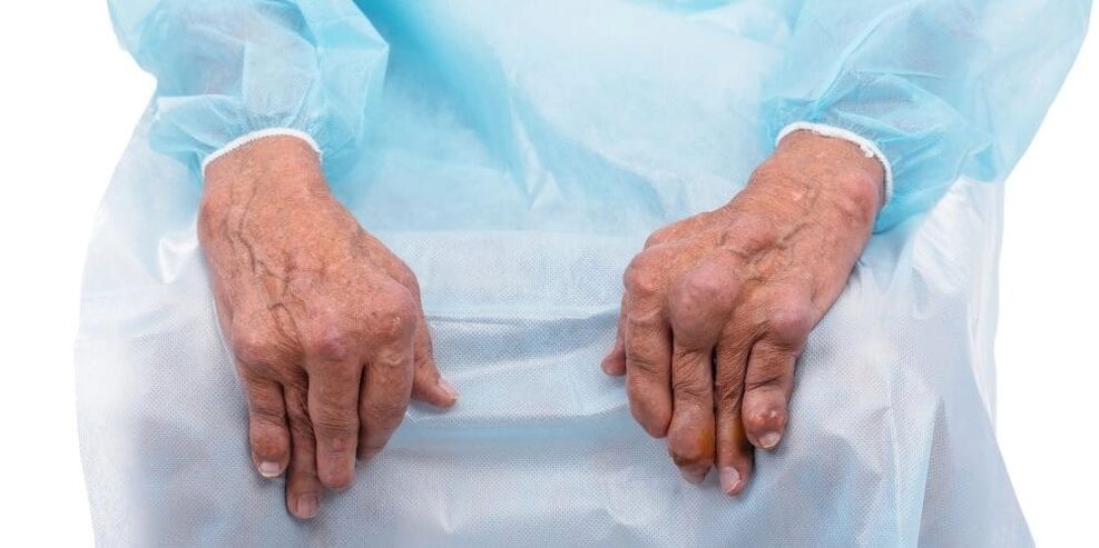 Infectious arthritis is a disease that causes constant pain and changes in the finger joints.
