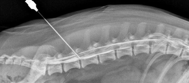 spinal blockade with osteonecrosis