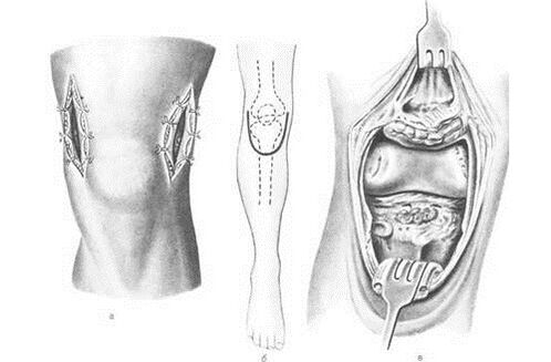 Arthrectomy for joint disease