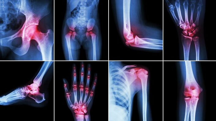 The joints of the body are affected by arthritis