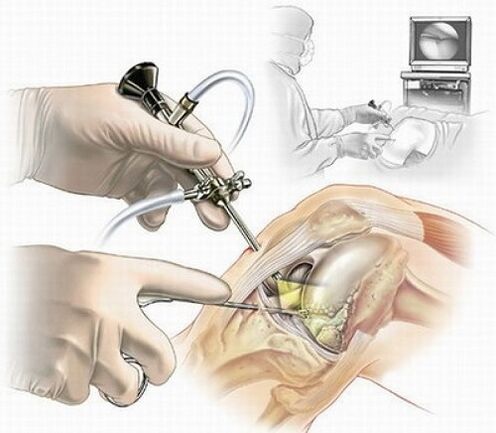 knee arthroscopy to treat knee osteoarthritis